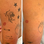 A nova tendência é apagar o que antes era eterno, o boom da remoção de tatuagens no Brasil